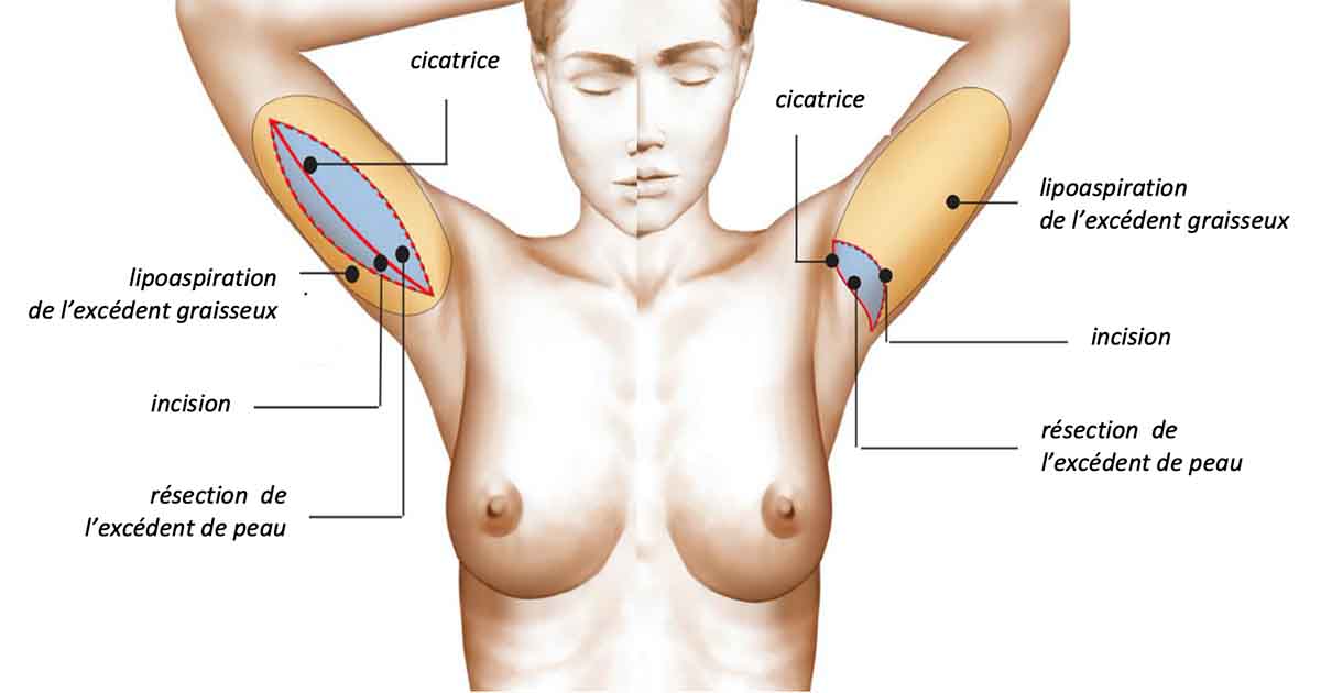 Lifting des bras (lifting brachial ou brachioplastie) à Paris : Dr