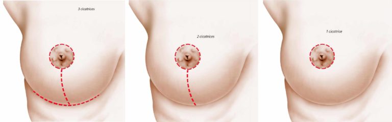 Cicatrices réduction mammaire