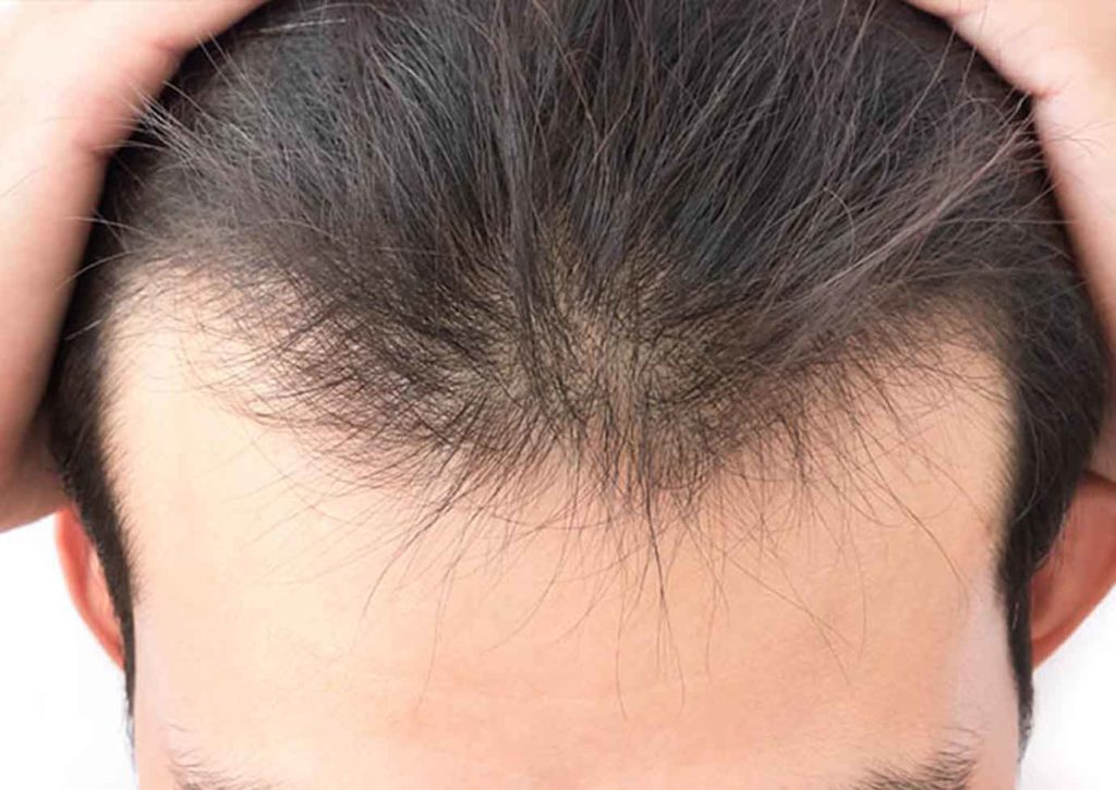 Greffe cheveux Paris | Dr Silhol Paris