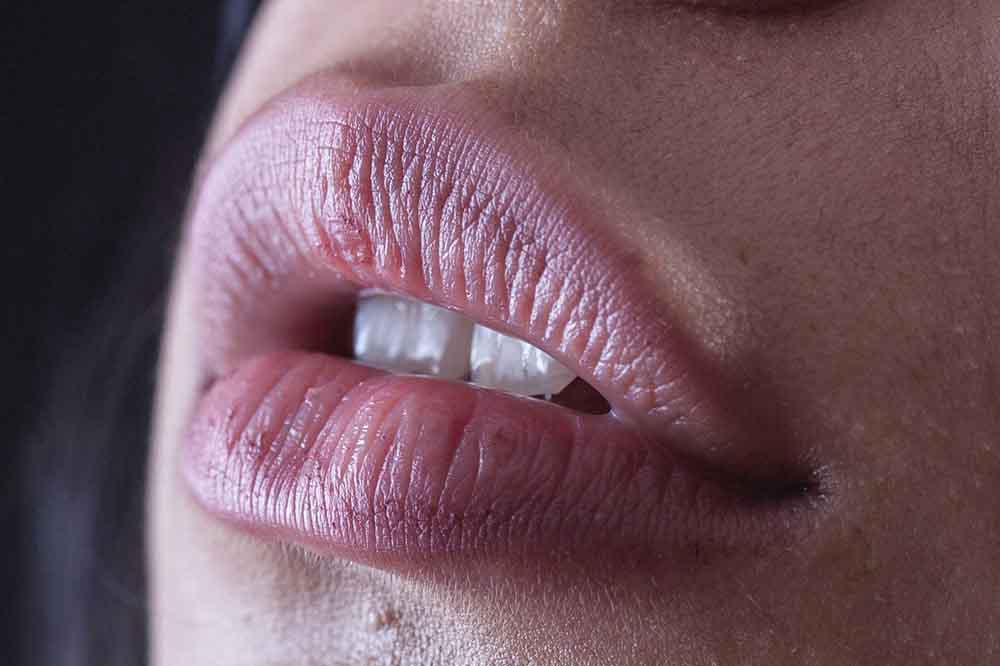 Russian lips - Lifting lèvre supérieure