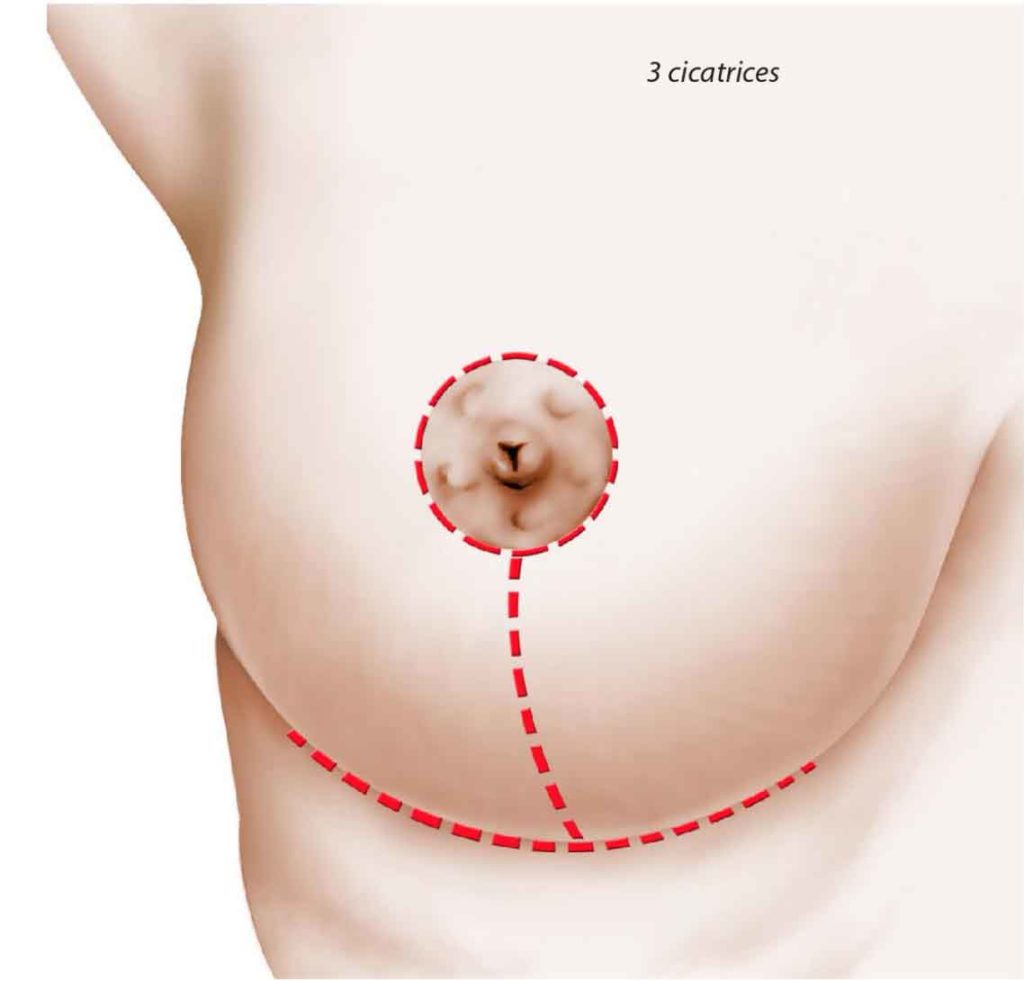 Réduction mammaire cicatrice | Dr Silhol Paris