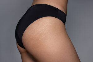 Augmentation des fesses par implants | Dr Silhol | Montpellier et Paris