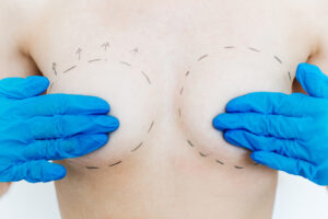 Réduction mammaire | Dr Silhol | Montpellier et Paris